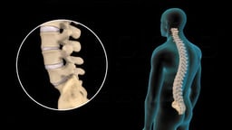 Lumbar Disc Injuries and Treatment