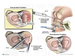 Right Medial Flap Meniscal Tear with Arthroscopic Repair