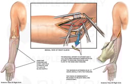 Decreased Circulation to the Right Arm and Hand; Brachial Artery Repair and Fasciotomy