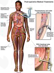 Post-operative Medical Treatments