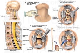 C4-5 Disc Herniation with Surgical Repairs