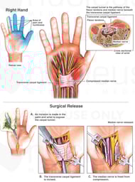 Carpal Tunnel Syndrome and Surgical Release: Right Hand
