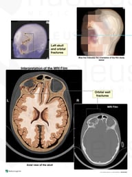 MRI Evidence of Brain Injury