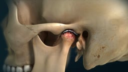 Temporomandibular Joint (TMJ) Arthritis