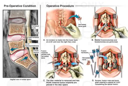 Lumbar Spine Injury with Surgical Decompression and Fusion
