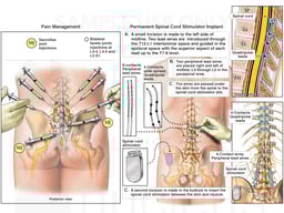 Spinal Cord Stimulator Implantation