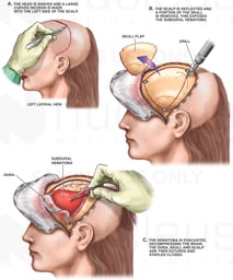 Brain Surgery - Surgical Repair of Subdural Hematoma