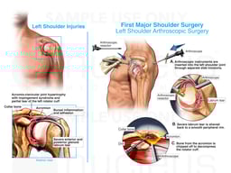 Multiple Shoulder Surgeries