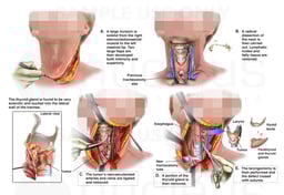 Total Laryngectomy and Radical Neck Dissection