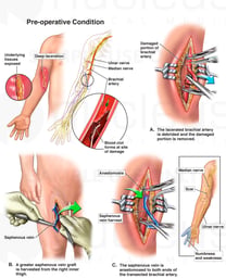 Right Arm Damage with Vascular Surgery