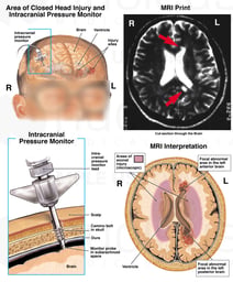 Post-traumatic Brain Injuries with Placement of Intracranial Pressure Monitor (ICP)