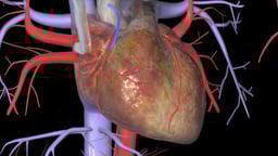 Coronary Artery Bypass Graft (CABG)