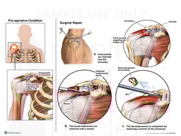 Right Shoulder Injuries with Surgical Repair