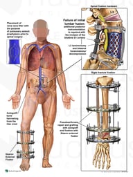 Additional Surgical Fixation Procedures
