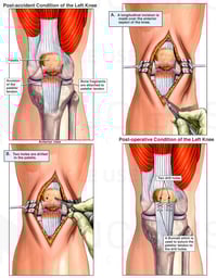 Knee - Patellar Injury and Surgical Fixation