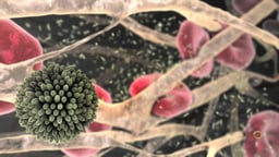 Heart Attack Due to Atherosclerosis (Full version)