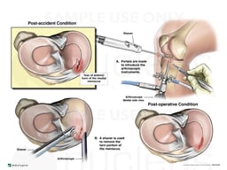 Right Medial Anterior Horn Meniscal Tear with Arthroscopic Repair
