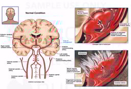 Rupture of Middle Cerebral Artery Aneurysm