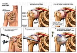 Right Shoulder Injury with Arthroscopic Repairs