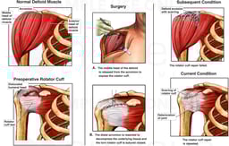 Rotator Cuff Tear of the Shoulder with Subsequent Condition