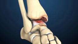 Ankle Joint with Arthritis