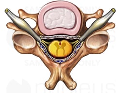 Cervical Vertebra with Disc and Spinal Nerve Roots