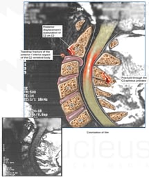 Cervical Disc Injury