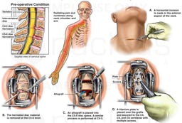 Spine Surgery - Herniated Discs with Anterior Cervical Spinal Fusion Procedure