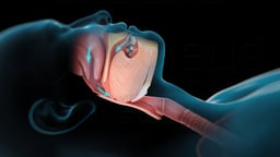 Obstructive Sleep Apnea