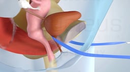 Transobturator Tape Procedure (TOT) for Stress Urinary Incontinence