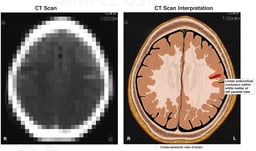 Post-accident Brain Injury