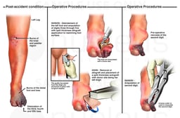 Left Foot and Leg Burns with Multiple Attempts at Surgical Repair