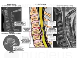 Cervical Spinal Cord Trauma and Cervical Disc Herniation
