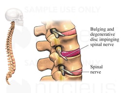 Impinged Spinal Nerves