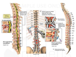 Additional Spine Injury with Extension of Fusion Up to T3
