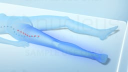 Restless Leg Syndrome