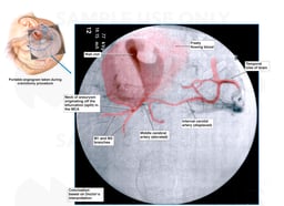 Angiogram Image of Cerebral Aneurysm