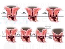 Cervix Length Reduction
