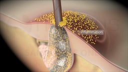 Bacterial Infection of a Clogged Hair Follicle (Labeled)