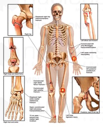 High-speed Rollover Motor Vehicle Accident Injuries