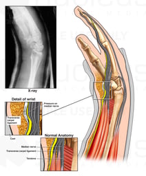 Surgical Fusion of Wrist and Finger Fixation