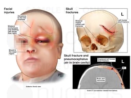 Traumatic Head Injuries