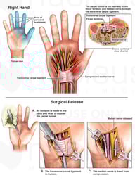 Carpal Tunnel Syndrome and Surgical Release