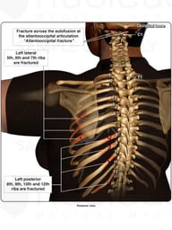 Fractures Sustained in a MVA