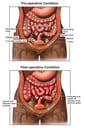 Peritonitis
