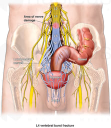 Lumbar Spine Fractures Causing Nerve Damage
