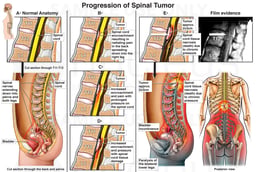 Lumbar Fracture and Subsequent Pelvic Nerve Dysfunction