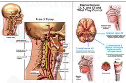 Carotid Endartarectomy with Cranial Nerve Damage