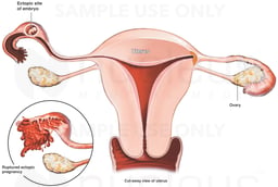 Ruptured Ectopic Pregnancy