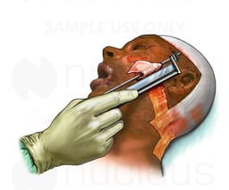 Third and Fourth Degree Burns and Skin Resection
